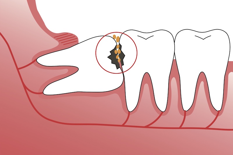 Wisdom Teeth FAQ Calgary AB Foundation Oral Surgery